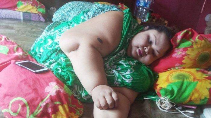 Titi Wati Wanita Tergemuk di Kalteng sudah bisa duduk tiga minggu setelah operasi pengecilan lambung atau operasi Bariatrik