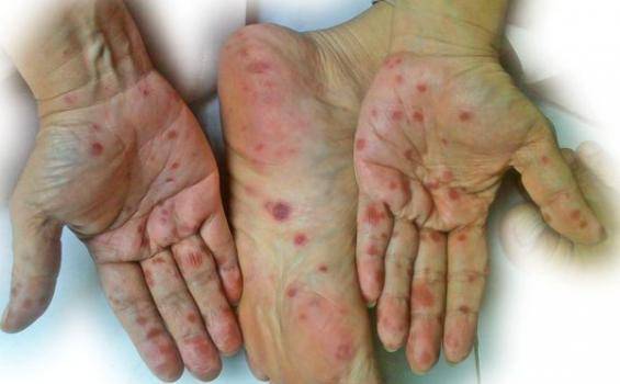 0807 - flu singapura