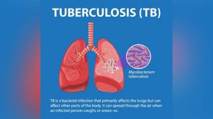 TBC Masih Mengancam Jogja!  Ada 900 Kasus,  Ratusan di Antaranya Anak-anak